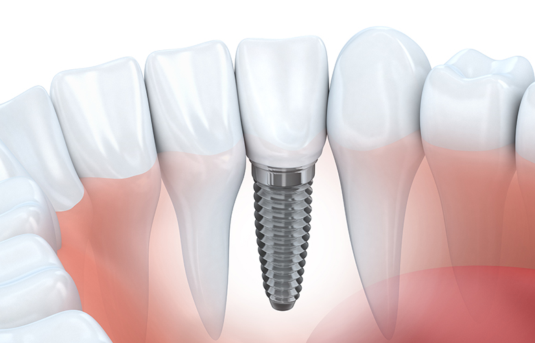 Implantes dentales