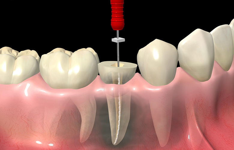 Endodoncia