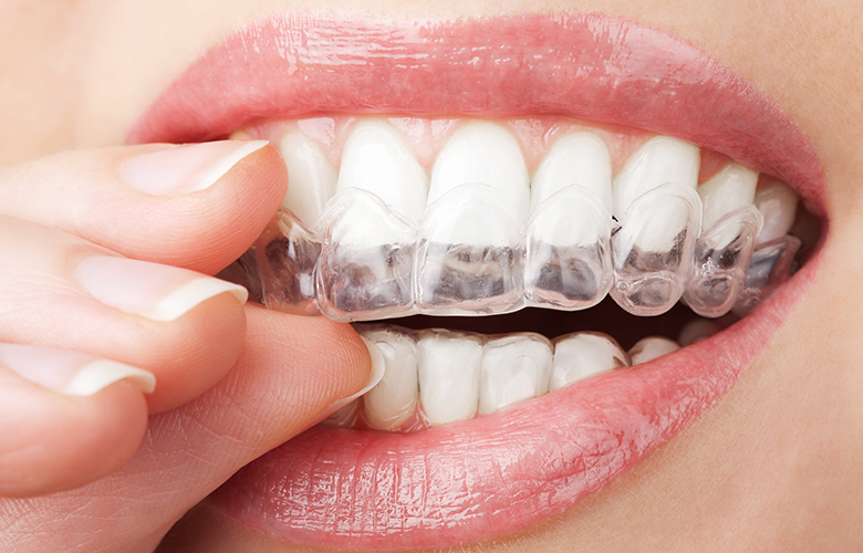 Invisalign®