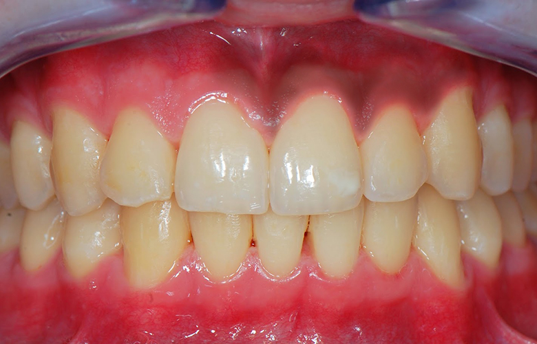 Melanosis gingival