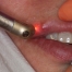 cc_herpes_labial_laser